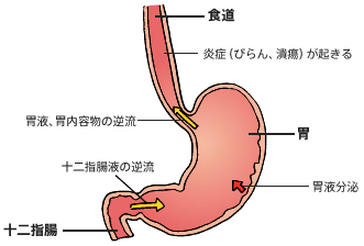 逆流性食道炎でお困りの方