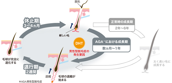 男性型脱毛症のヘアサイクル